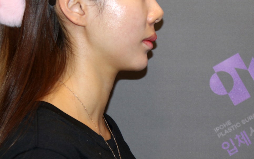 [Chin Surgery] Learning About Contouring Shaving and T-Osteotomy with Real Patient Cases (3) image 12