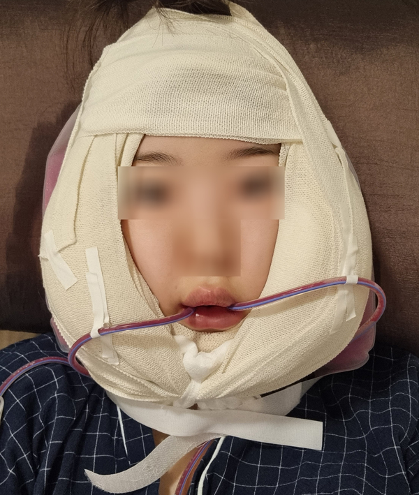 윤곽수술 후 피주머니 꼭 착용해야 하나요? 관련 이미지 1