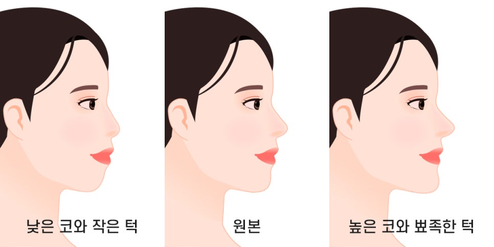 돌출입과 무턱은 윤곽수술로 교정이 가능할까요? 관련 이미지 8