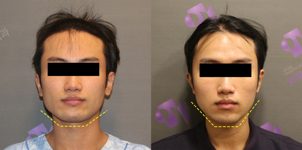 남자사각턱, 남자다운 턱선이 중요한 안면윤곽수술 관련 이미지 4