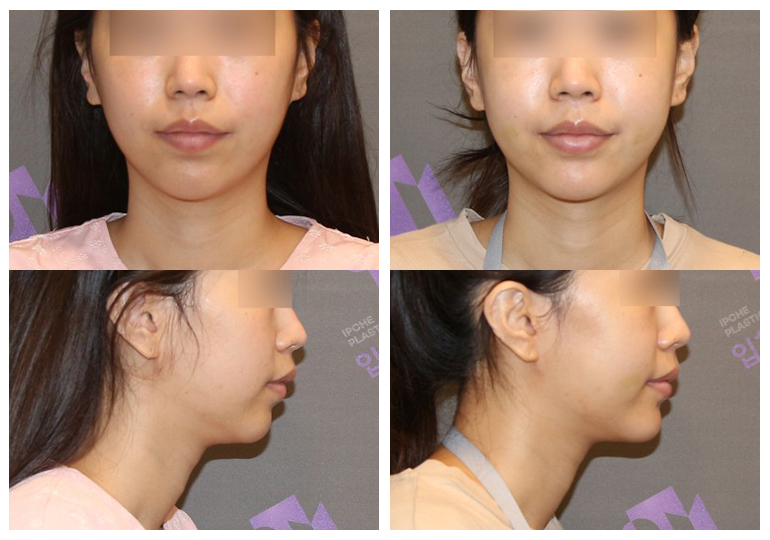 Why Are There So Many Different Chin Surgery Methods? Exploring Advancement, Setback, Reduction, and Lengthening image 7