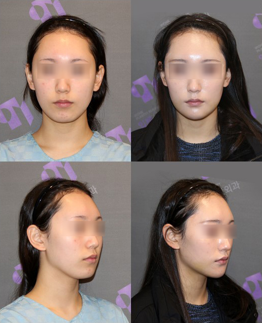 T-Genioplasty Techniques That Vary Depending on the Shape of the Chin image 3