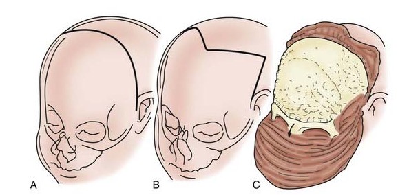 Key Techniques in Forehead Reduction Surgery - Trichophytic and W-Plasty Incisions image 1