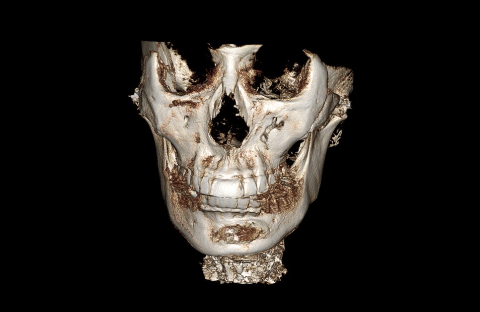 Does chin filler or an implant cause bone erosion? image 2