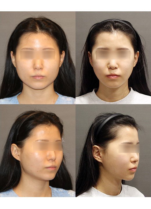 Is masseter muscle resection really necessary for square jaw reduction? image 3