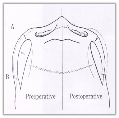 Why Are There So Many Methods for Cheekbone Surgery? A Look at Osteotomy Methods image 1