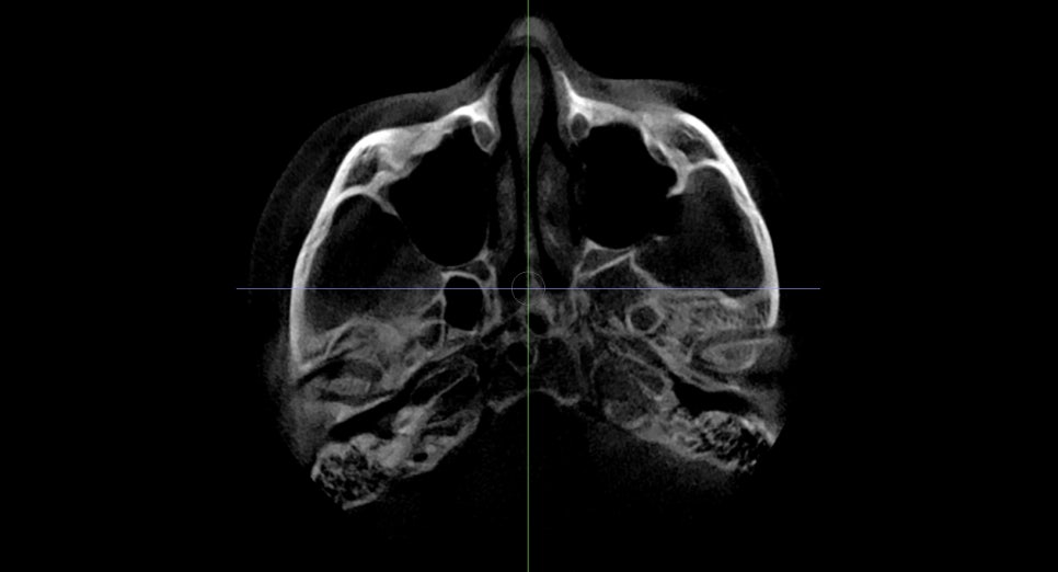 After cheekbone reduction surgery, is there still a back cheekbone left? Is there a solution? image 5
