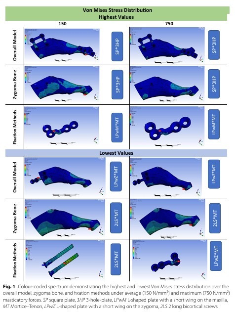 [Paper Review] What Matters More in Zygoma Reduction Than Double or Triple Fixation image 2