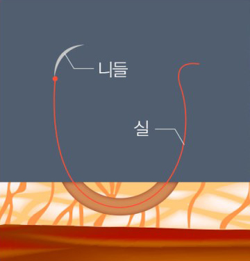 이마축소 수술 부작용 걱정된다면, 고정 방식부터 확인하세요! 관련 이미지 5