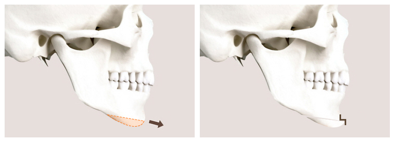 Can Chin Advancement Surgery Adjust Chin Length? image 3