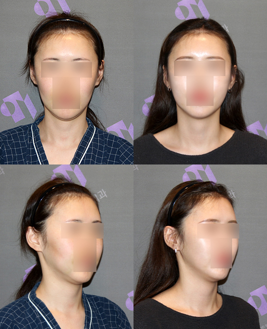 How effective is the incision method compared to the non-incision method for cheek hollow correction? image 4