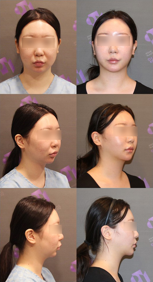 What Surgery Is Needed for a Long, Recessed Chin or a Short, Recessed Chin? image 5