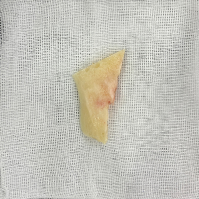 Are There People Who Can’t Have Cortical Ostectomy Surgery for a Frontal Square Jaw Effect? image 3
