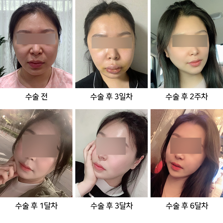 안면윤곽 붓기 빨리 빼는 법 총정리 - 성형외과 전문의가 알려드립니다 관련 이미지 4