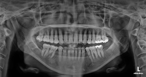 Long Midface and Lower Face Long-Face, Long-Chin Surgery - Cases That Do Not Require Double-Jaw Surgery image 9
