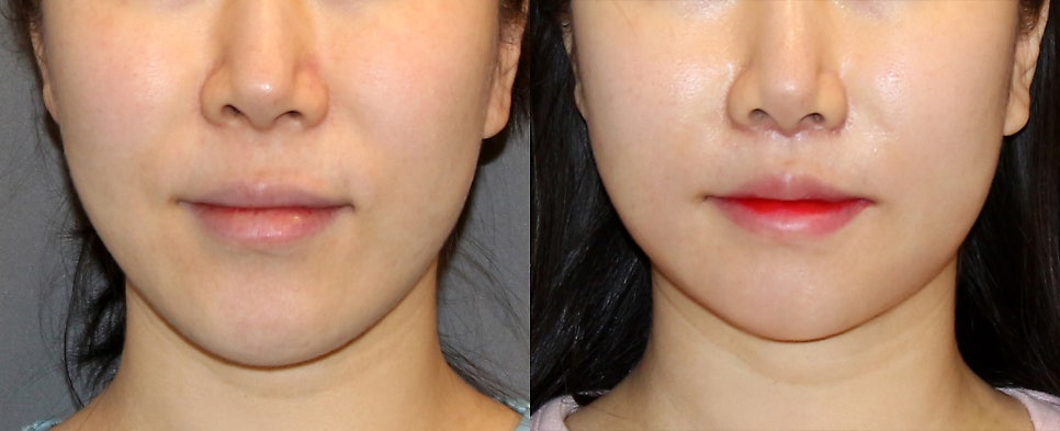 How to Adjust Long-Face Proportions: Philtrum Reduction Surgery image 2