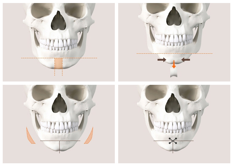 What Side Effects Can Occur After Chin Surgery? image 5