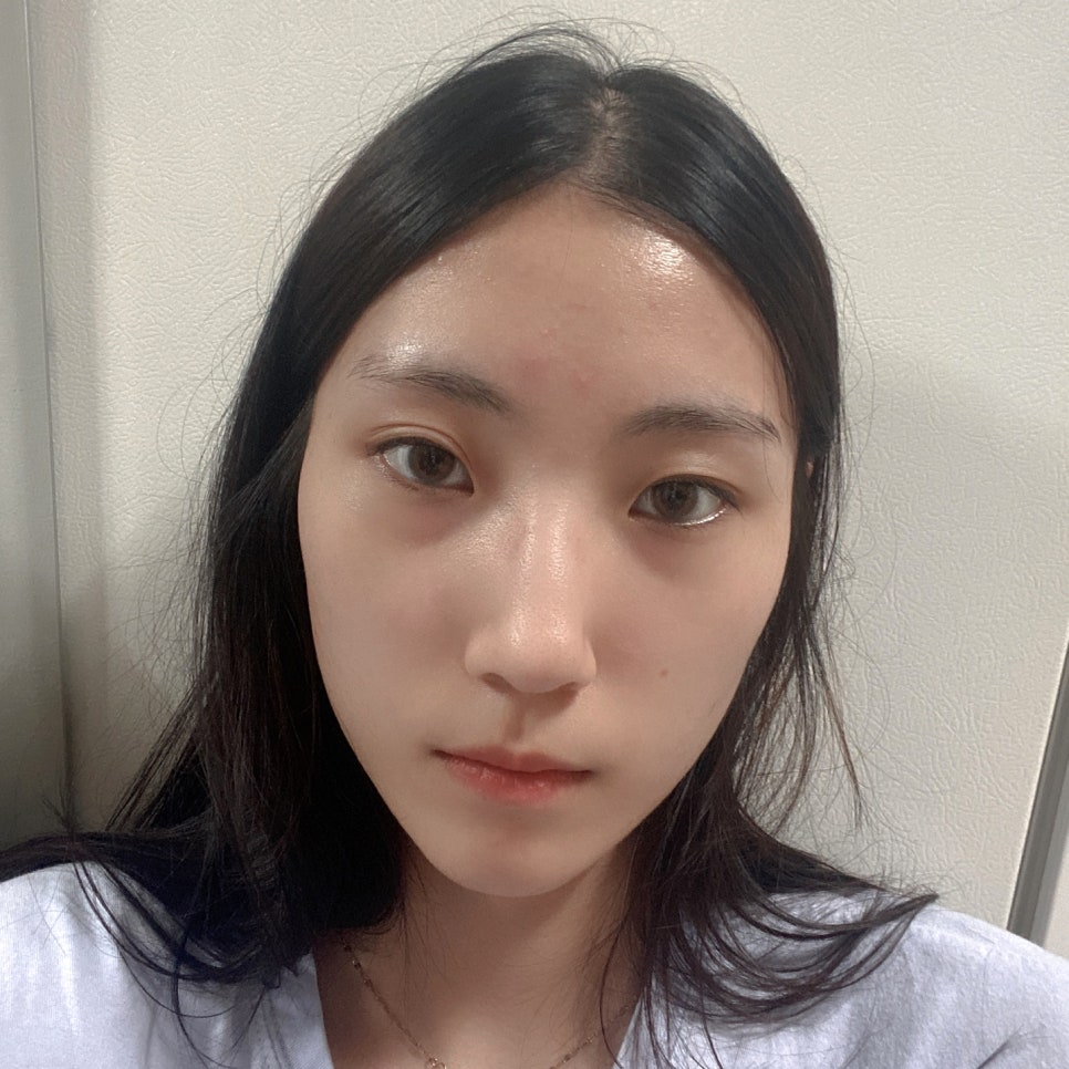 Surgery That Goes Well with Cheekbone Surgery, Part 1: Lateral and Lower Canthoplasty image 1