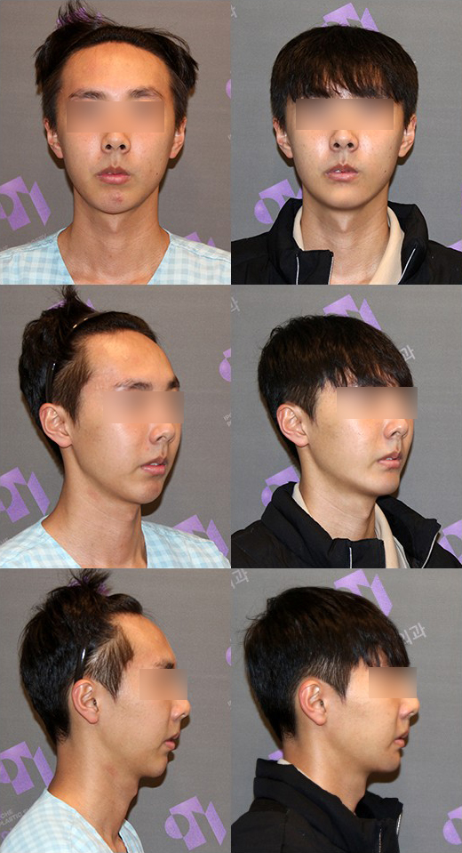 Can Chin Advancement Surgery Adjust Chin Length? image 8