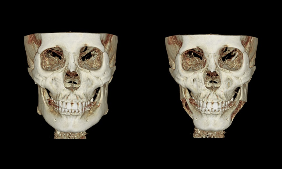 Facial Contouring A to Z: What Is Contouring Surgery? image 5