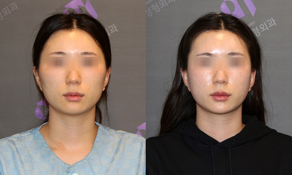 안면윤곽, 많이 가져오는 연예인 사진은? 관련 이미지 8