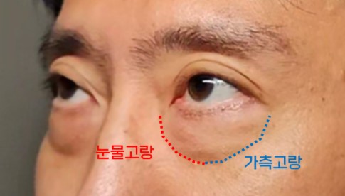 50대 남자눈성형 하안검 수술 케이스 - 세대별 분석으로 접근한 해결 전략 관련 이미지 5