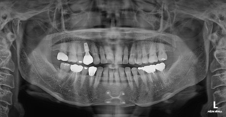 Are There Cases Where Pin Removal Is Difficult After Double Jaw or Contouring Surgery? image 4