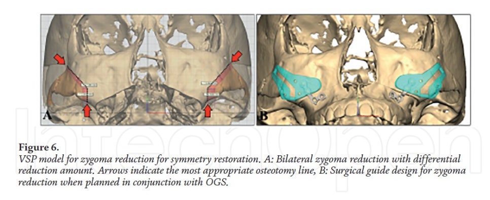 [Paper Review] Technological Advances and Real-World Applications in Modern Facial Contouring Surgery: Correction of Facial Asymmetry image 7