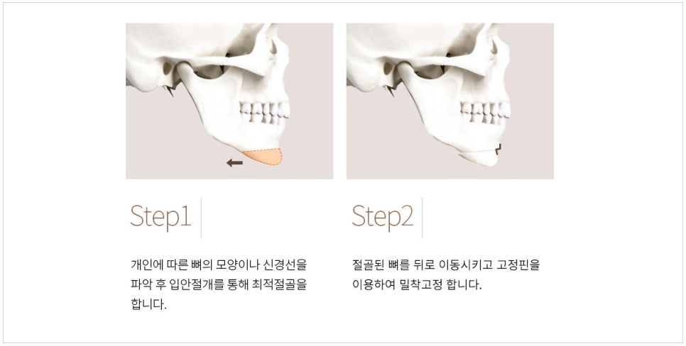 주걱턱 교정은 어떤 수술이 좋을까요? 턱끝후진술의 한계와 실제 결과 관련 이미지 1