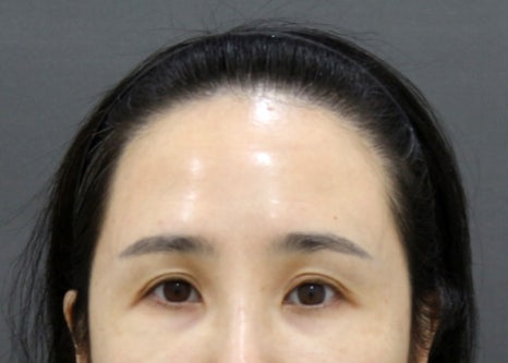 3D프린터 보형물을 이용한 안구함몰, 함몰눈 교정의 실제 사례 관련 이미지 1