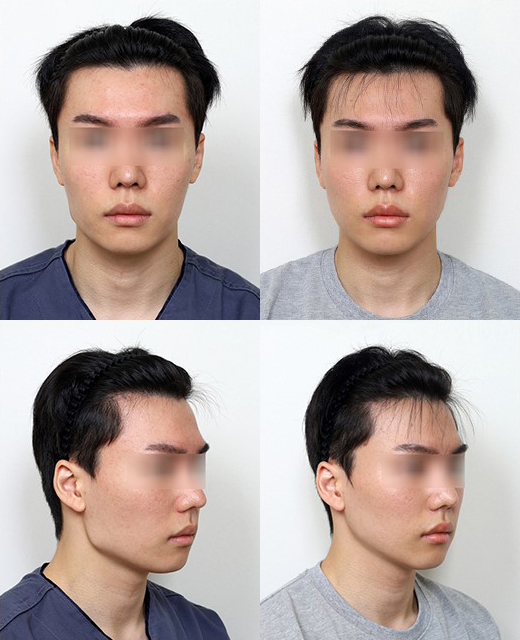 원장님, 윤곽수술하면 예뻐지는 게 맞나요? 관련 이미지 6
