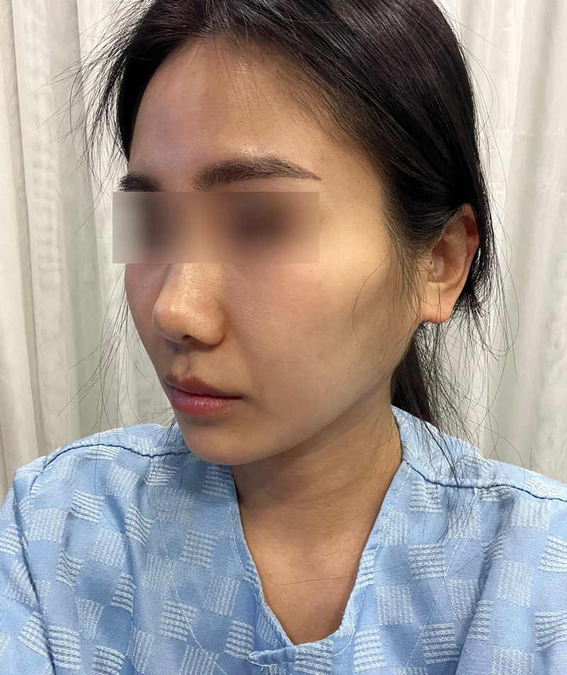 Side Effects That May Occur After Contouring Surgery and the Appropriate Solutions image 2