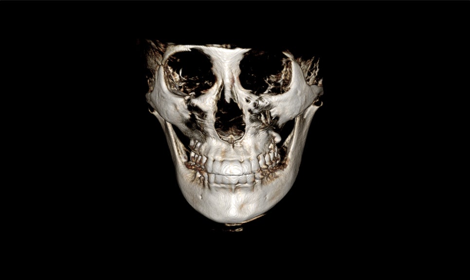 V-Line Square Jaw Surgery Is Good for the Front View Effect image 4