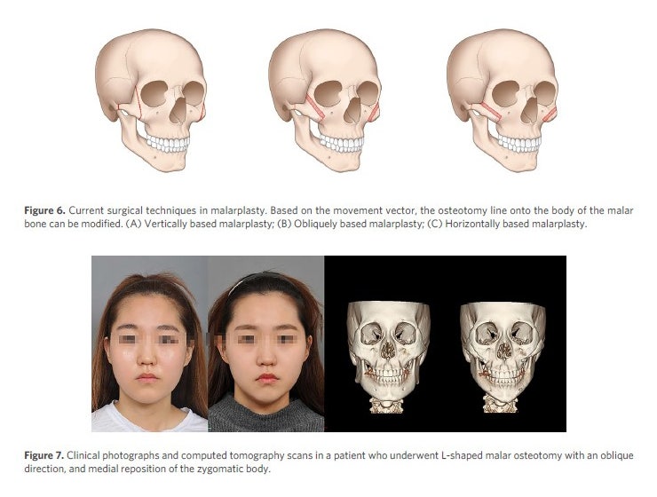 [논문 리뷰] 아시아인 안면윤곽수술에 대해서 관련 이미지 8