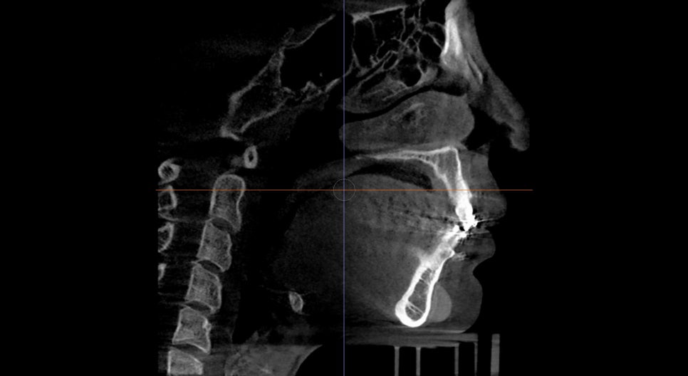 What Surgery Is Best for Correcting a Recessed Chin? The Limits of Chin Advancement Surgery and the Actual Results image 8
