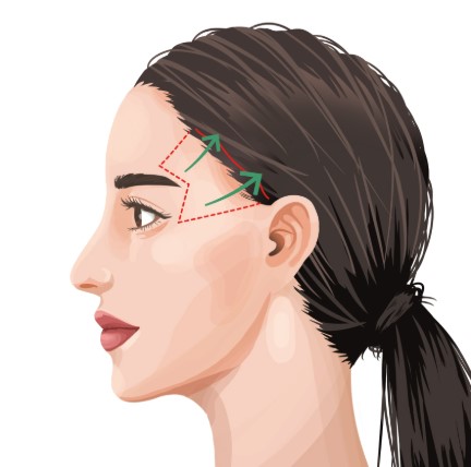 How Far Should Forehead Lift Dissection Go? Is More Fixation Always Better? image 4