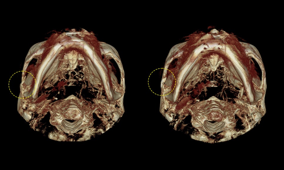 Can Overcorrection of the Cheekbones Be Reversed? image 7