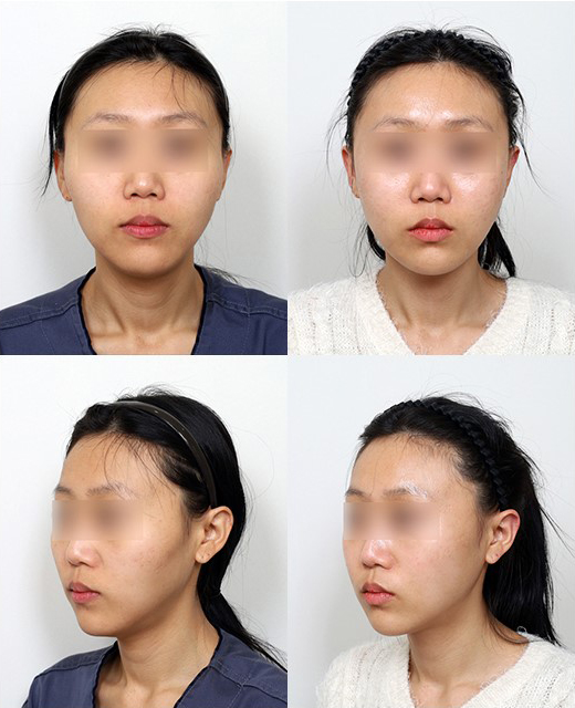 광대축소술, CT에서 무엇을 봐야 수술 결과를 예측할 수 있을까? 관련 이미지 8