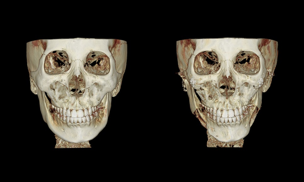 Facial Contouring A to Z: What Is Contouring Surgery? image 2