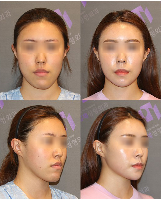 안면윤곽수술로 안면비대칭 교정할 수 있을까요? 관련 이미지 2