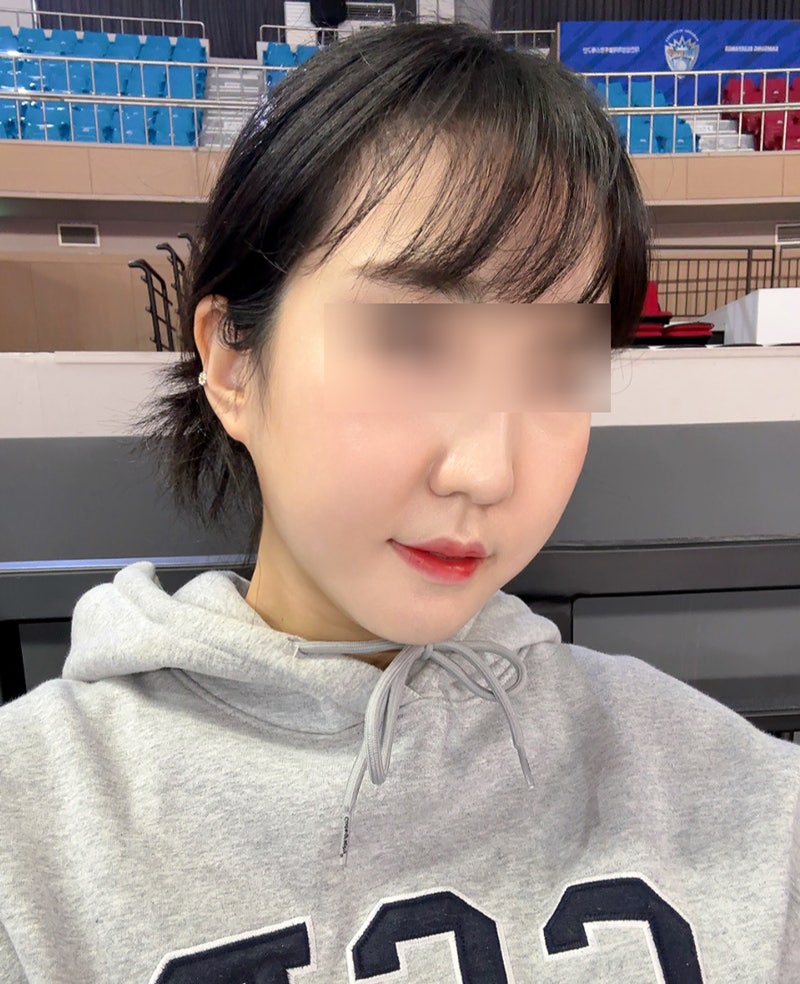 How Long Do Facial Contour Changes Continue After Facial Bone Contouring Surgery? (Day 1 to Day 365) — See With Photos image 6