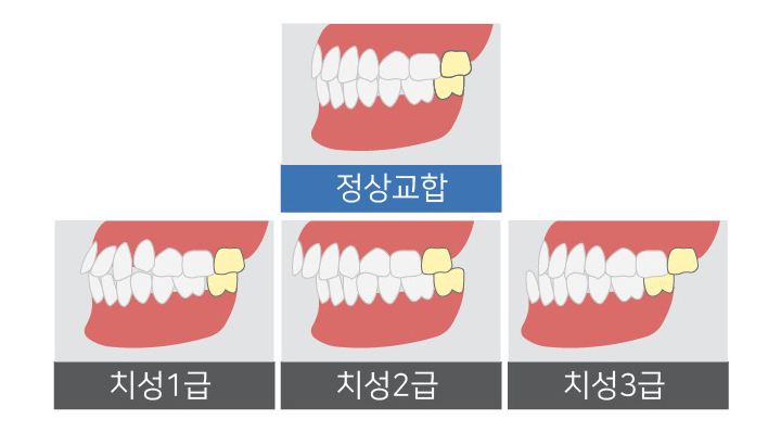 Which Surgery Do I Need: Contouring Surgery or Double-Jaw Surgery? image 1
