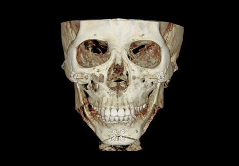 Are There Cases Where Pin Removal Is Difficult After Double Jaw or Contouring Surgery? image 1