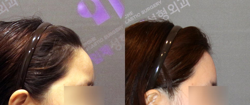 Forehead Fat Grafting Side Effects: Is There a Way to Remove Excess Fat? image 10