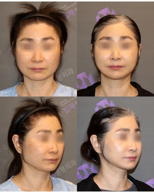 꺼진 얼굴 vs 처진얼굴 어떻게 해결해야 할까요? 관련 이미지 4