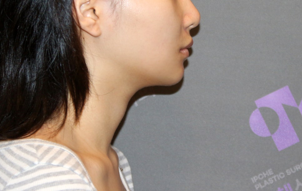 [Chin Surgery] Learning About Contouring Shaving and T-Osteotomy with Real Patient Cases (3) image 16