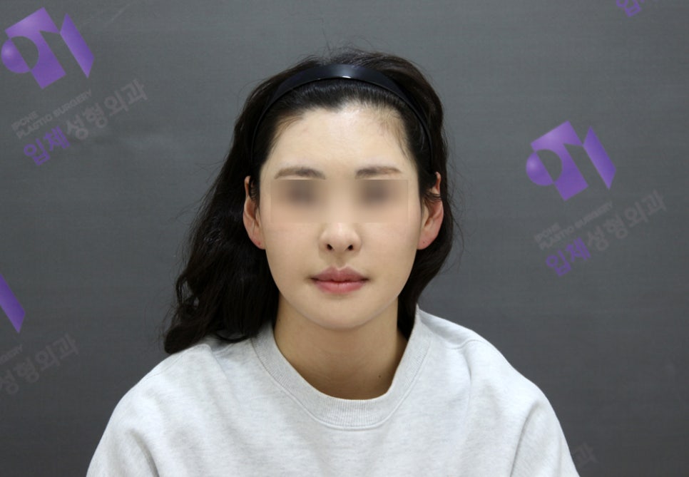 Long Midface and Lower Face Long-Face, Long-Chin Surgery - Cases That Do Not Require Double-Jaw Surgery image 7