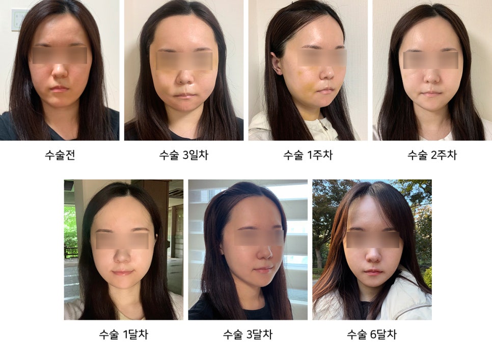Eating, Exercise, and Swelling Management After Facial Contouring Surgery - Explained by a Specialist image 4