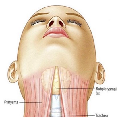 A Complete Guide to Submental Lift Surgery: A New Approach to Solving a Double Chin image 2