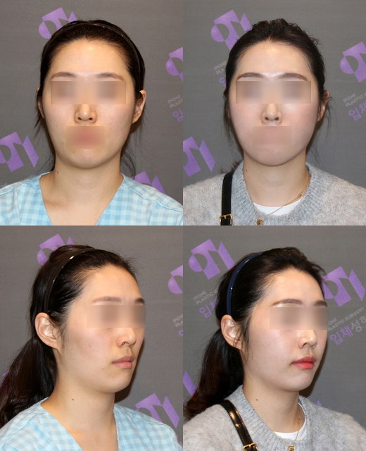광대수술과 볼패임 교정을 같이 할 수 있나요? 관련 이미지 5
